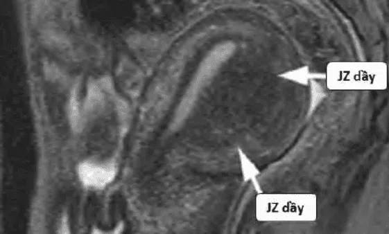 Adenomyosis trên MRI
