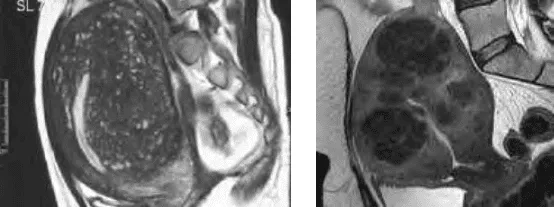 Hình ảnh MRI của adenomyosis và u xơ tử cung