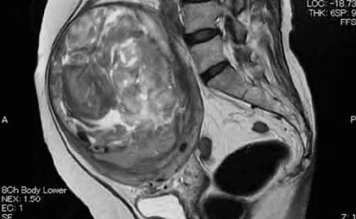 Leiomyosarcoma trên MRI