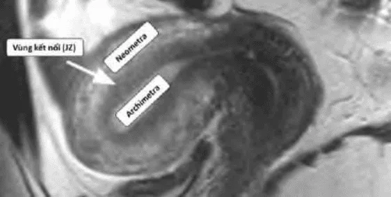 Tử cung bình thường trên MRI