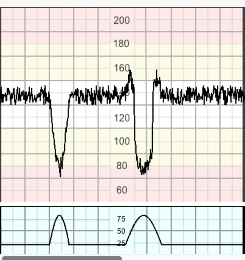 Nhịp giảm biến đổi (Variable)