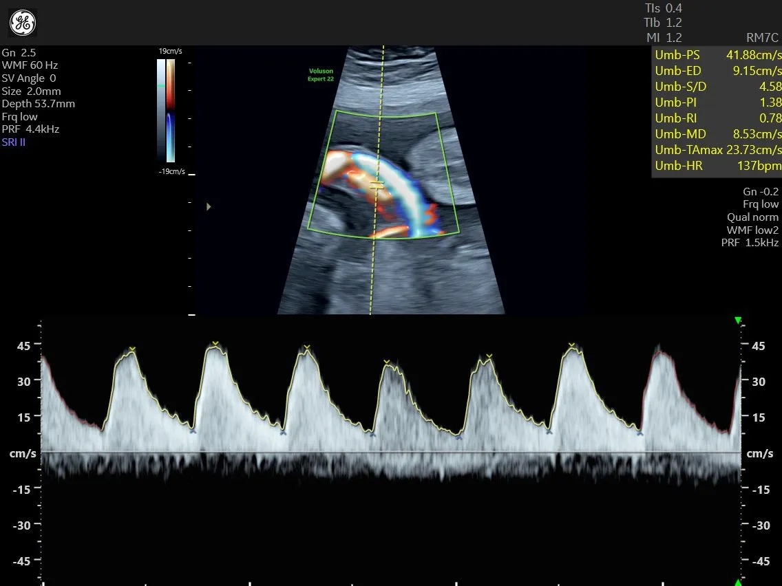 Phổ sóng Doppler động mạch rốn bình thường ở quý 3