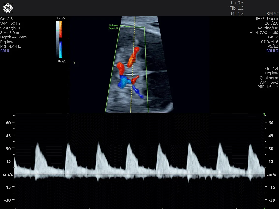 Phổ sóng Doppler động mạch não giữa (MCA) ở quý 3