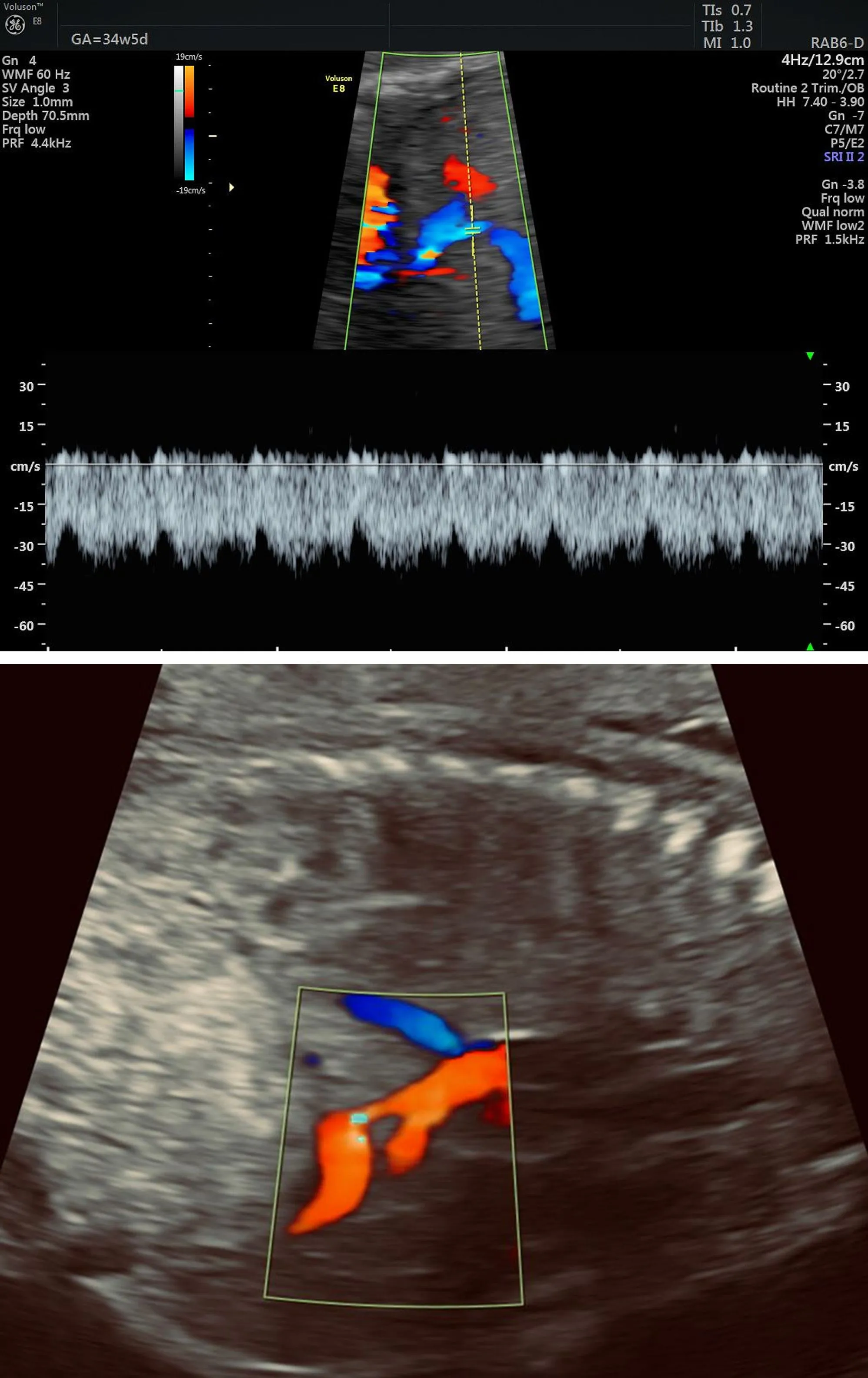 Phổ sóng Doppler ống tĩnh mạch (Ductus Venosus) ở quý 3