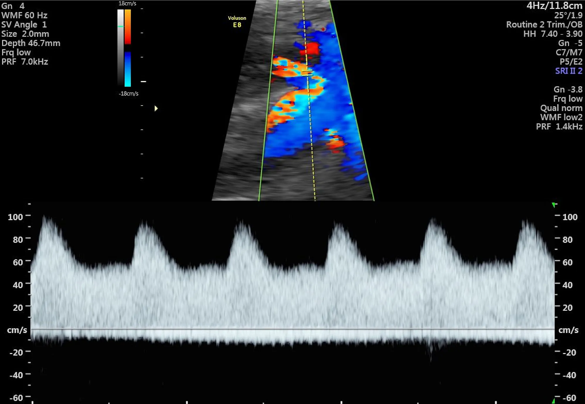 Phổ sóng Doppler động mạch tử cung mẹ ở quý 3