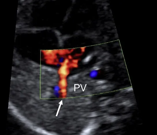 Hình ảnh Doppler màu cắm tĩnh mạch phổi vào nhĩ trái