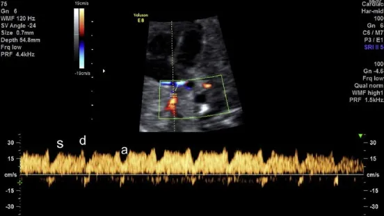 Phổ Doppler xung 3 pha tĩnh mạch phổi bình thường